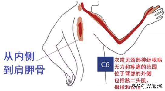 颈神经根炎的症状与治疗:颈椎椎间盘突出C3C4C5压迫神经根及硬膜囊是什么症状？