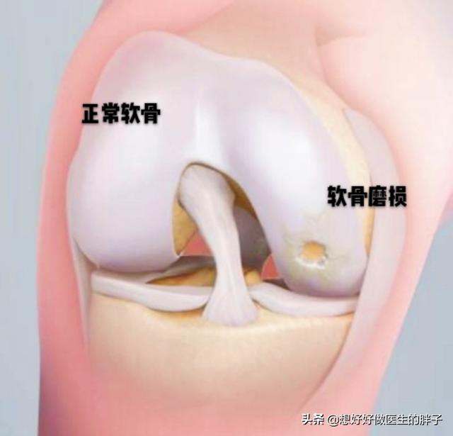 膝盖软骨磨损和风湿什么区别:软骨磨损是因为风湿吗 膝关节软骨轻度磨损怎么办？能自愈吗？