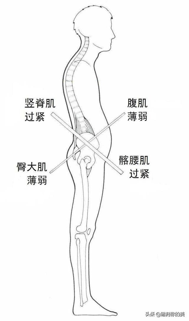 练臀能调整骨盆前倾吗？