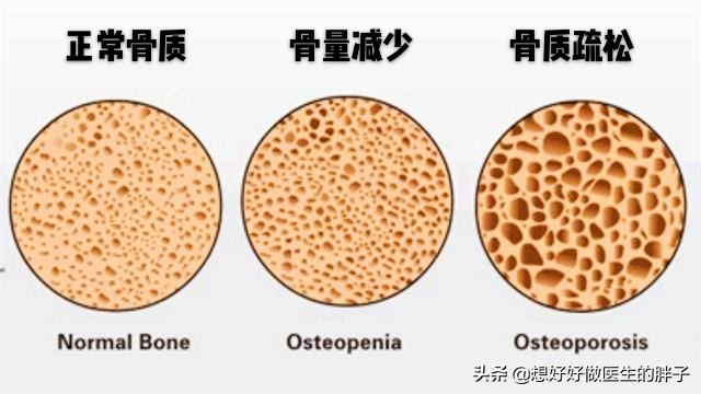 吴好运医生:去医院检测出骨密度偏低，应该怎么办？