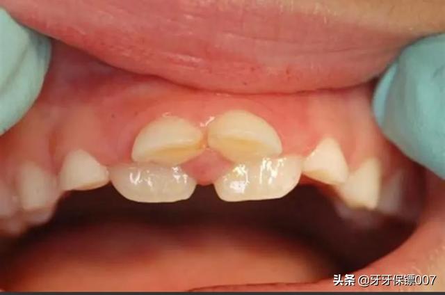 儿童补牙(儿童补牙一般多少钱一颗)