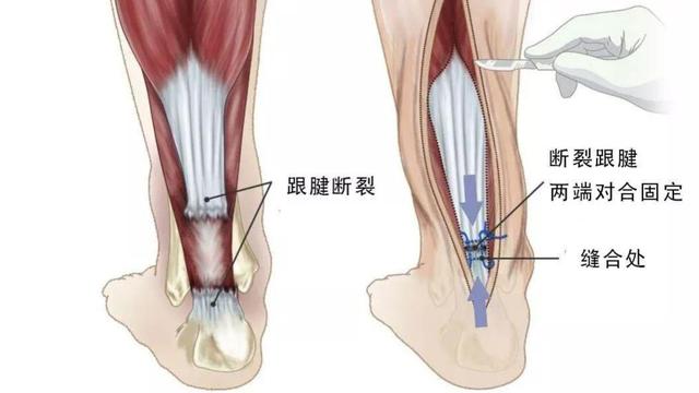 跟腱清创手术有危险吗:易建联小腿肌肉萎缩，杜锋还会让他参加国际比赛吗？