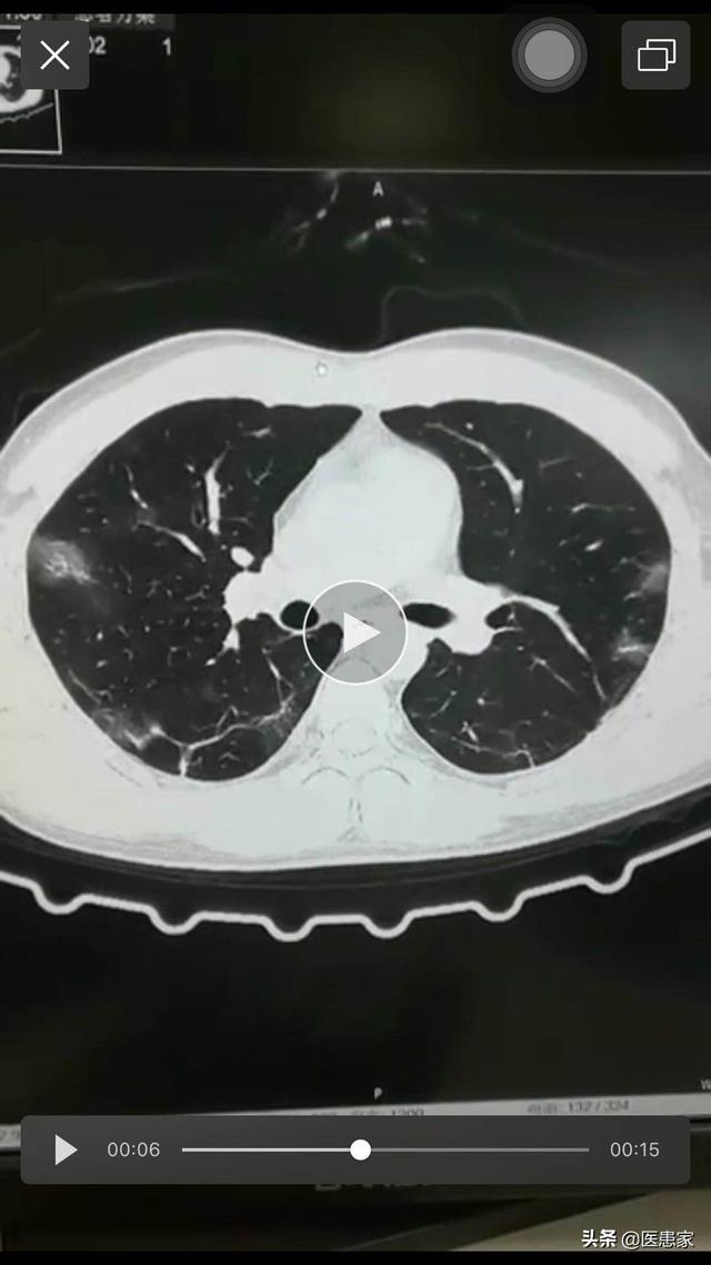 新冠肺炎的肺部图片图片