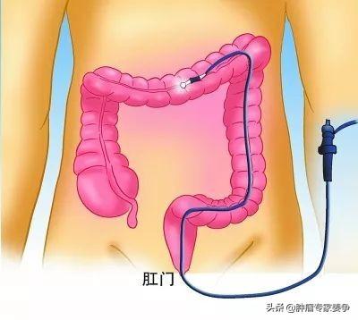 肚疼拉肚子便血是怎么回事:哪些人最易患腹痛便血，查出肠癌？