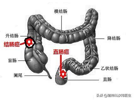 怎么判断自己得了痔疮,怎么判断自己得了痔疮还是肛裂