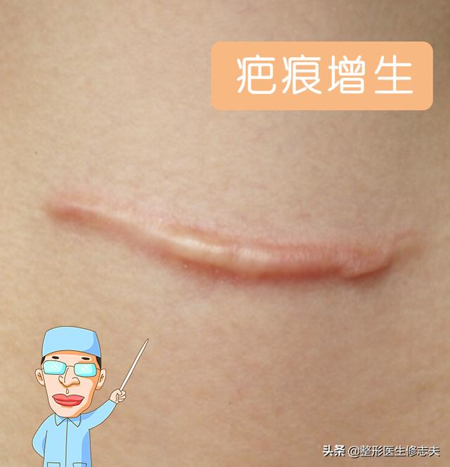 疤痕性体质(疤痕性体质是什么原因导致的)