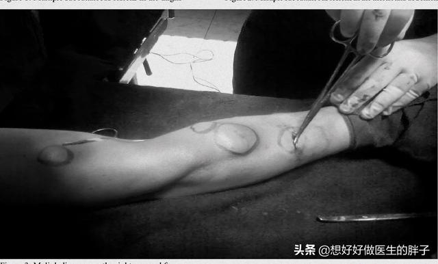 头上长包会得癌吗:脂肪瘤会变成恶性肿瘤吗？