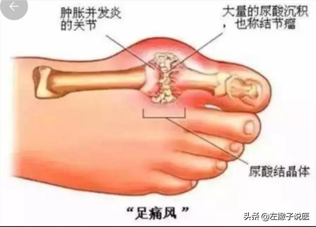 车前草对痛风有什么用？