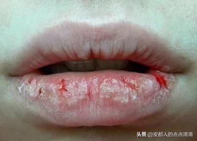 嘴唇干裂怎么快速恢复，人的嘴唇干裂出血是怎么回事该怎么办