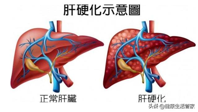 肝硬化的症状有哪些(肝硬化的症状有哪些)