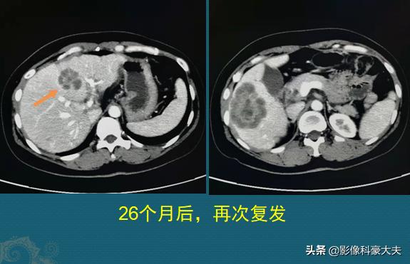 化疗什么情况下用红药水:化疗用的红药水叫什么 癌症化疗时出血，是肿瘤恶化了吗？