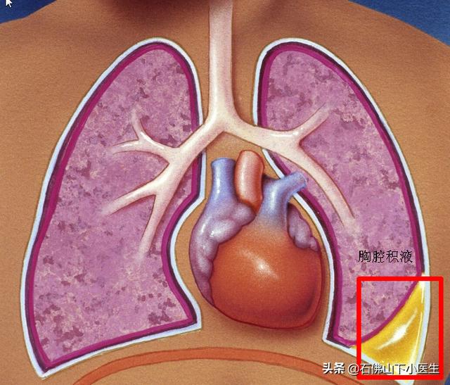 胸腔积液常见的原因是什么，导致右侧胸腔积液的原因有哪些