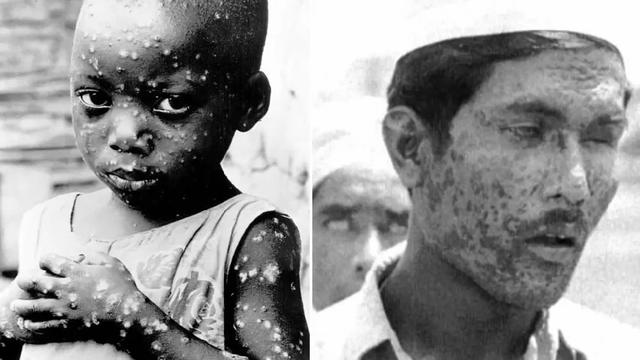 古代人所说的"天花"是什么病?为什么那时候的人闻其色变?