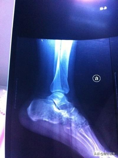 头条问答 胫骨中上段骨折 保守治疗3个月 错位三分之一且有少量骨痂形成 该怎么办 杨家谈骨的回答 0赞