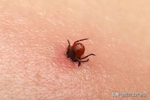 人被蜱虫叮咬后会危及生命？为什么？