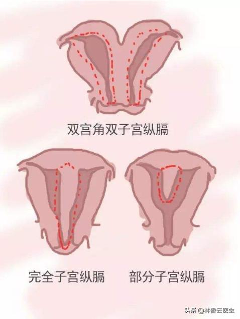 孕38周了不全纵隔子宫需要注意什么?