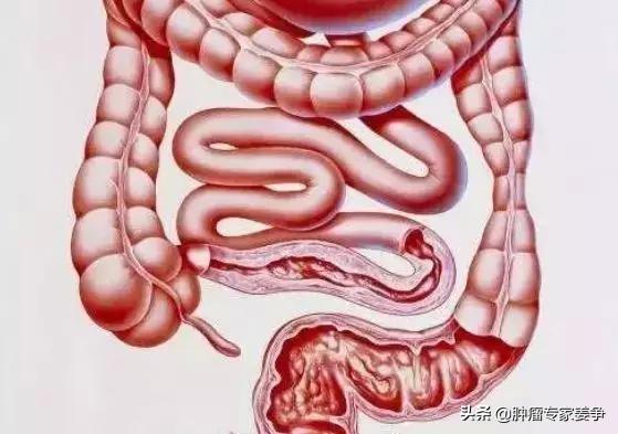 悟空问答 光做肠镜不做活检能判断溃疡性结肠炎吗 7个回答