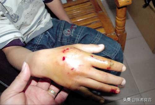 被狗狗咬了没出血打不打针:被小狗咬了没有流血，要打狂犬疫苗吗？ 被狗咬了没出血要不要打针