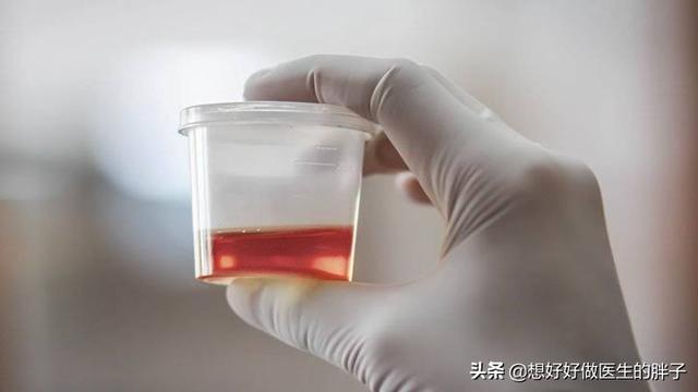 膀胱处痛小便带血:带导尿管几天后尿痛有血什么原因？