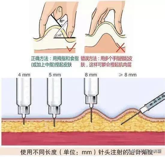 糖尿病打针部位图片