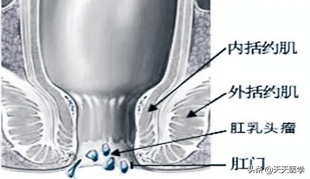 疑似莱姆病症状:得尖锐湿疣的典型症状有哪些？ 莱姆病的症状