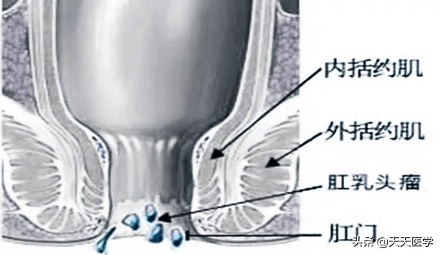 尖锐湿疣的危害(湿锐尖疣多长时间潜伏期)