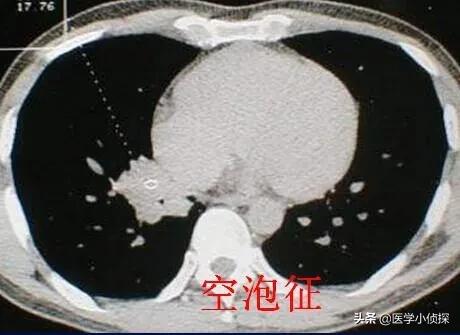 养生堂代茶饮方治疗肺部结节,肺结节喝什么水好能散结？