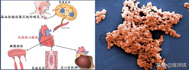 心脏病的早期症状:心脏病的早期症状预防 风湿性心脏病都有哪些症状？