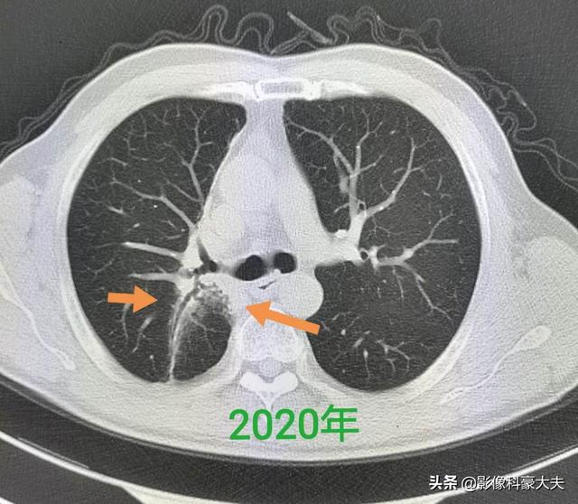 不影响寿命的十大癌症:哪些癌症是已发现且好治疗的？ 不影响寿命的十大癌症 肾癌