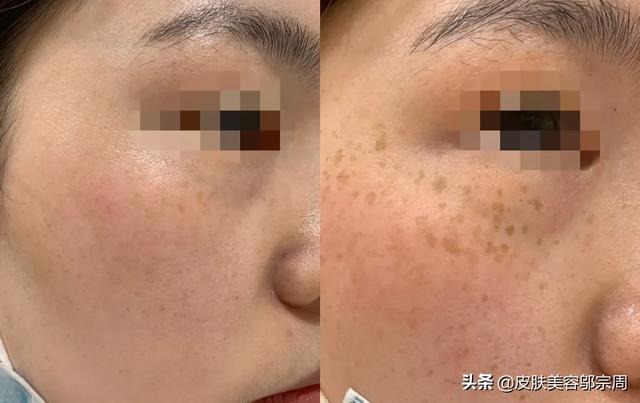 调q激光祛斑(调q激光祛斑多少钱一次)