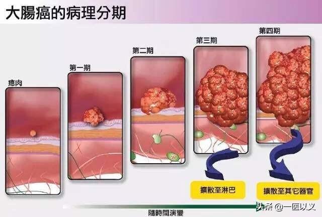 预防肠道疾病教学设计:幼儿园预防肠道疾病教案 引起肠癌的原因有哪些？肠癌能预防吗？