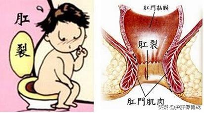 排便前面拉稀带血丝后面正常:前段时间大便带血，现在又没有了，是什么原因？