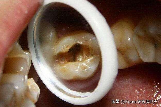 牙齿分为哪几种图一共几个图片:牙齿老是隐隐作痛?到底是犯了什么牙病？