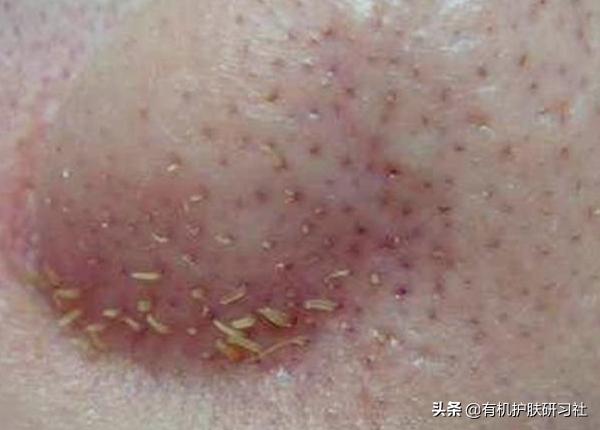 面部螨虫图片:脸上的毛孔居然是“螨虫养殖场”，这是为什么？怎么除掉螨虫？