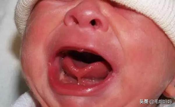 宝宝舌头开裂:请问婴儿伸出舌呈轻微w型怎么办？