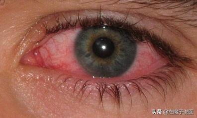 眼疲劳有什么症状,肝不好的人眼睛会出现哪些信号？
