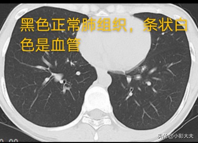 头条问答 为什么感染新型冠状病毒后 肺部ct是全白呢 是患者自身原因吗 125个回答