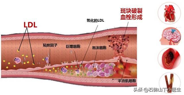 冠心脏病的症状有哪些:冠心病和其他心脏病的症状有什么不同？