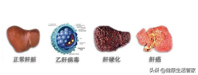 肝硬化的症状有哪些(肝硬化的症状有哪些)