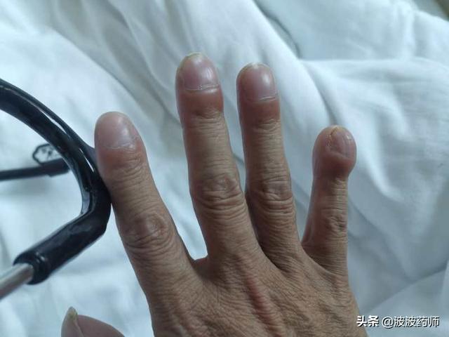 头条问答 - 肺癌发病不一定咳嗽吗?手和脸有哪些症状?(3个回答)