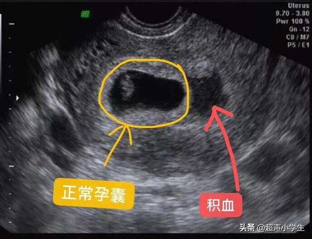 怀孕四周可以看到孕囊吗 应该注意哪些事项 头条问答