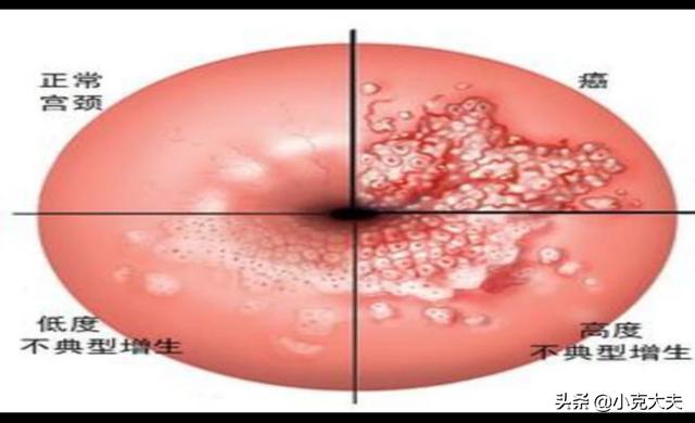 宫颈癌发出的第一个信号:宫颈癌早期的3个信号是什么？