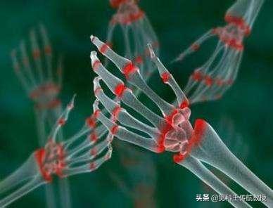 类风湿可以治吗,类风湿能否治愈，国外有吗？