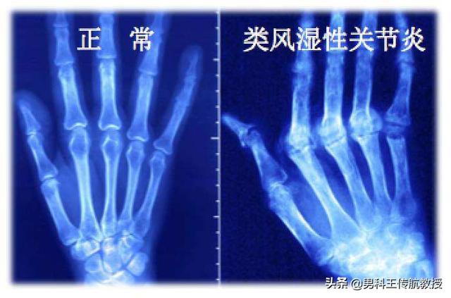 类风湿可以治吗,类风湿能否治愈，国外有吗？