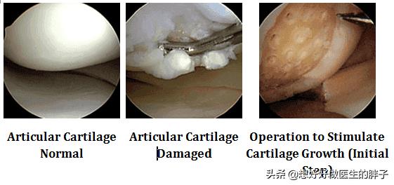 膝盖软骨磨损吃什么号:膝关节软骨磨损了能复原吗？怎么办？
