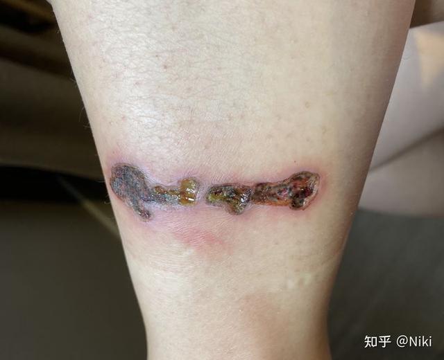 洗纹身图片广西桂林那个地方洗纹身的技术好
