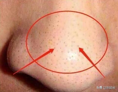 面部螨虫图片:脸上毛孔如“橘皮”，越来越粗，跟什么因素有关呢？螨虫可能吗？