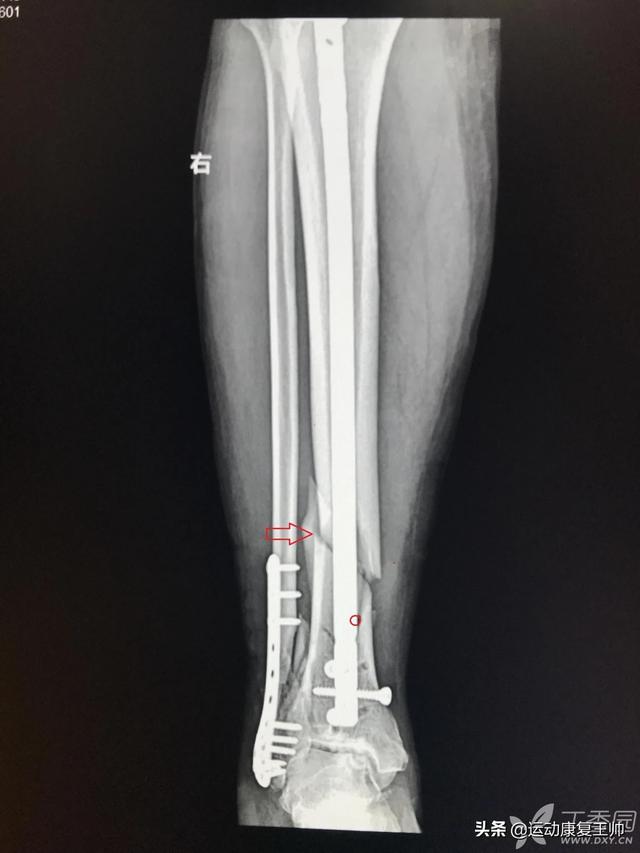 头条问答 左小腿胫腓骨骨折五十天了 做内髓内钉怎么锻炼 战狼在世l的回答 0赞