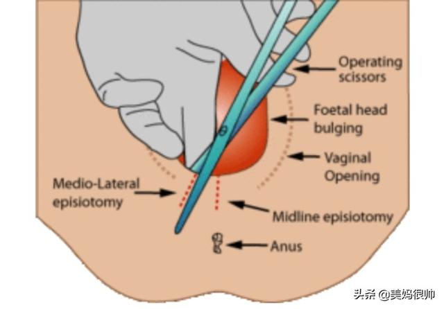 顺产最怕遇到的侧切很多准妈妈直接选择剖腹产其实是可以避免的怎样