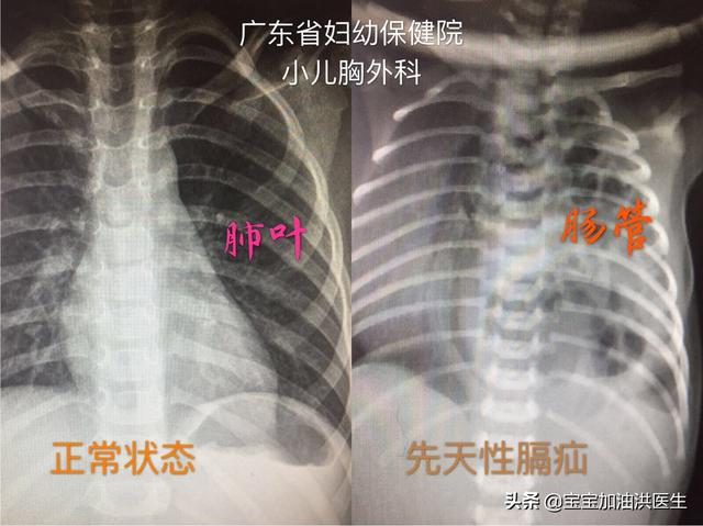 膈疝宝宝的恢复过程:左侧膈疝？膈疝是什么病？